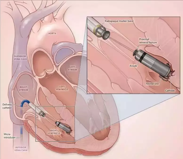 全國首批！遼西首例！葫蘆島市第二人民醫(yī)院心臟中心完成遼西首例Micra AV無導(dǎo)線起搏器植入術(shù)(圖2)