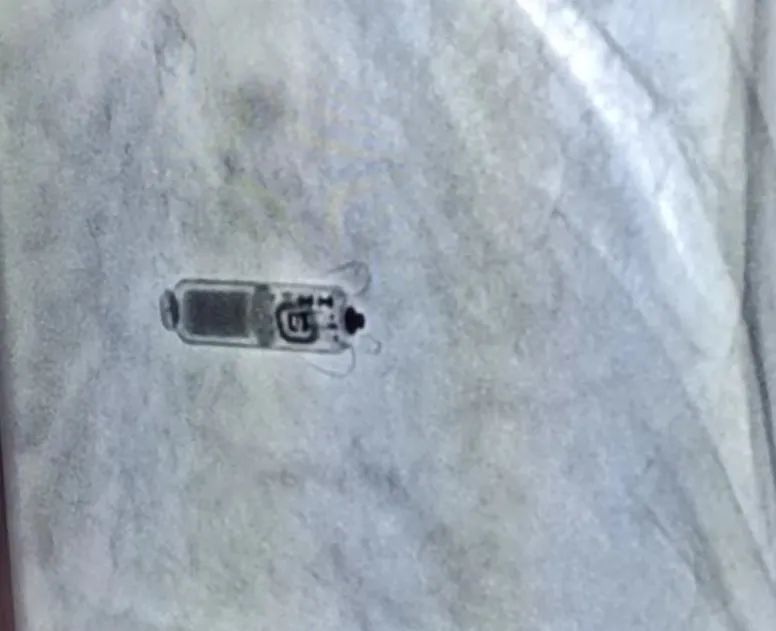 全國首批！遼西首例！葫蘆島市第二人民醫(yī)院心臟中心完成遼西首例Micra AV無導(dǎo)線起搏器植入術(shù)(圖4)