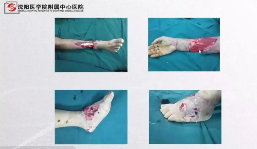 聚焦顯微外科|葫蘆島市醫(yī)學會顯微外科學分會第一屆第二次學術(shù)會議順利召開(圖8) 聚焦顯微外科|葫蘆島市醫(yī)學會顯微外科學分會第一屆第二次學術(shù)會議順利召開(圖8)