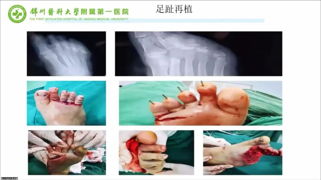 聚焦顯微外科|葫蘆島市醫(yī)學會顯微外科學分會第一屆第二次學術(shù)會議順利召開(圖16) 聚焦顯微外科|葫蘆島市醫(yī)學會顯微外科學分會第一屆第二次學術(shù)會議順利召開(圖16)